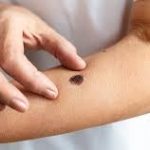 Mole Removal Trusted Medical Solutions