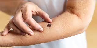 Mole Removal Trusted Medical Solutions